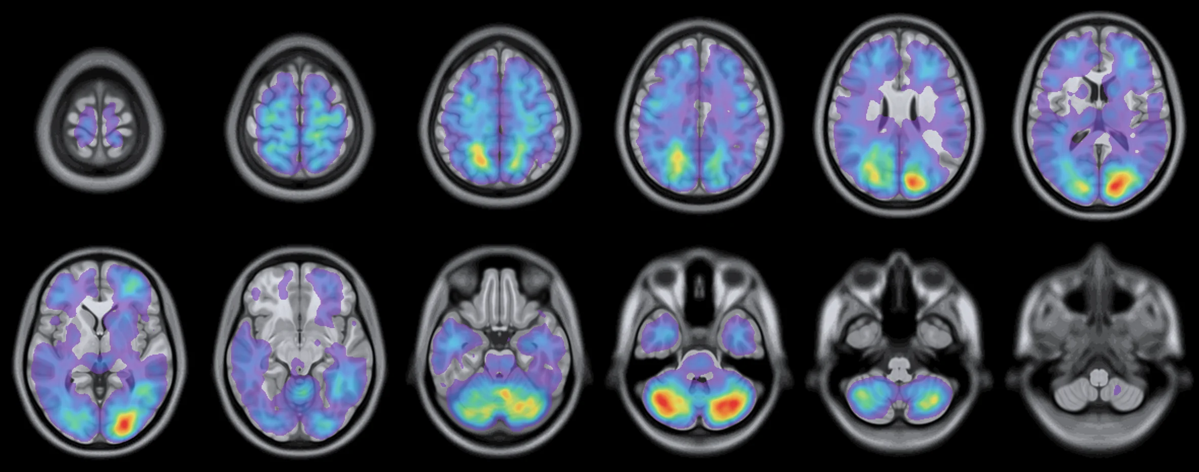 Twelve axial slices of the population brain metastasis frequency map, all primaries